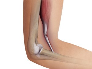 Bicep Tendon Tear at the Elbow